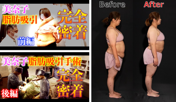 8児の母・美奈子さんがウエスト-10cmのサイズダウンに成功 共立美容外科にて脂肪吸引手術を受ける様子を収めたドキュメンタリーをYouTube「美奈子ファミリーTV」にて公開のメイン画像