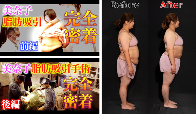 8児の母・美奈子さんがウエスト-10cmのサイズダウンに成功 共立美容外科にて脂肪吸引手術を受ける様子を収めたドキュメンタリーをYouTube「美奈子ファミリーTV」にて公開のサブ画像1